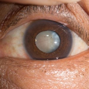 Cataracts Meaning, symptoms and cure